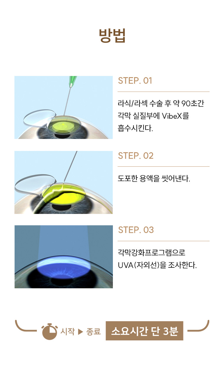강남 에이스 안과 | 각막강화술